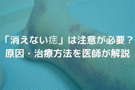 痣種類|「消えない痣(あざ)」は注意が必要？原因・治療方法。